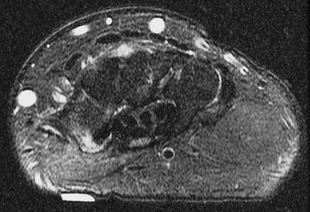 Figure 2 for case trapezial tubercle fracture ( RID2193 )